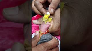 iv cannula kaise lagate hain intravenous cannulation shortsfeed [upl. by Straub5]