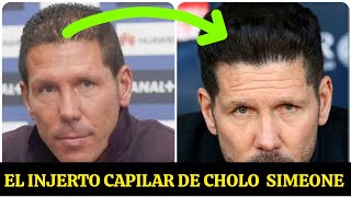 EL ANTES Y DESPUÉS DE INJERTO CAPILAR DE CHOLO SIMEONE EN 🇹🇷💪 [upl. by Ennasirk]