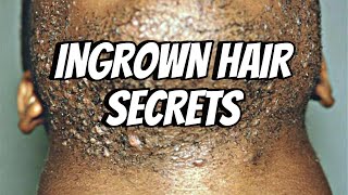 Everything You Need to Know About Ingrown Hairs Causes Prevention amp Treatment [upl. by Loriner594]