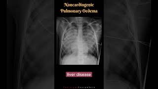 Noncardiogenic Pulmonary Edema Differential Diagnosis shorts radiologyshorts [upl. by Phina]