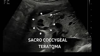 Sacrococcygeal teratoma at 22 weeksFollowup of this case httpsyoutubeYa59lnLs [upl. by Leiba]