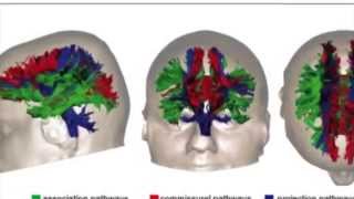 Brain Injury amp Diffusion Tensor Imaging DTI [upl. by Cull]