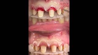 Surgical guide for gingiva Tommy and gingiviplasty [upl. by Ariahaj]