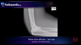 Elbow joint effusion and the sail sign  radiology video tutorial xray [upl. by Suriaj792]