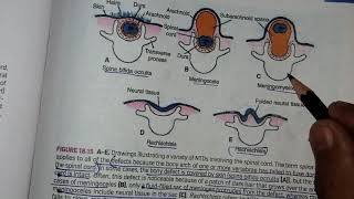 Neural tube defects an overview  Clinicals on CNS embryology [upl. by Chan]