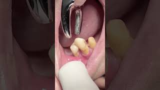 Extraction of upper first premolar tooth with mobility dentist smilteethcare teethwhitening [upl. by Nama]