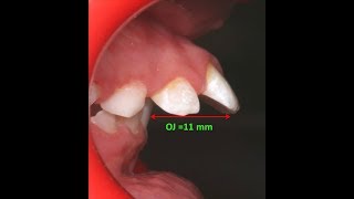 Amazing two phase treatment of Sever Class II Div 1  lama 10Y [upl. by Liatris]