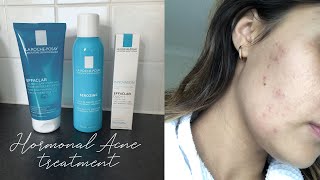 La RochePosay HORMONAL ACNE Treatment ➳ My Experience [upl. by Eiveneg]