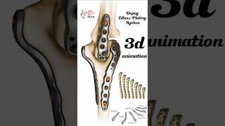 Depuy Elbow Plating System  3d animation short [upl. by Nottap]