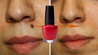 Nail Paint से तिल  मस्से और दाग ऐसे गायब होंगे जैसे कभी थे ही नहीं 100 Working  Remove Moles [upl. by Anev857]