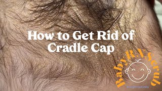 How to Get Rid of Cradle Cap  Frida Baby  Mustela [upl. by Fe527]