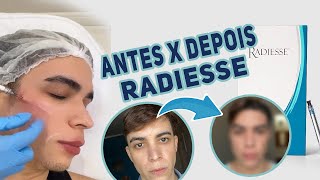 RADIESSE ANTES E DEPOIS [upl. by Ardnuek482]