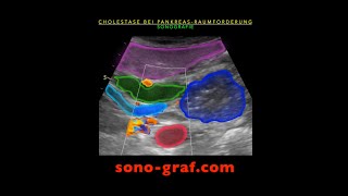 Sonographie  Cholestase bei Pankreaskopf Raumforderung [upl. by Samul381]