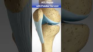 What happens when you tear your ACL acl knee kneepain [upl. by Yllaw]