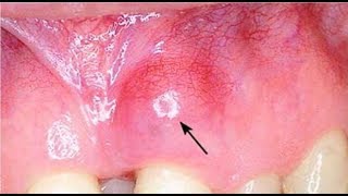 how to get rid of abscess on gum at home [upl. by Oremar]