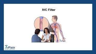 IVC Filter [upl. by Giguere]