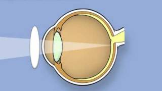 Retinoscopy of the eye Ophthalmology [upl. by Inaboy137]