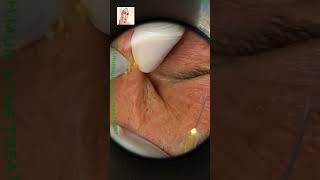 Blackheads Removal  Acne Treatment and Very Satisfying Satisfying Pimple pop blackheads [upl. by Ainegul]