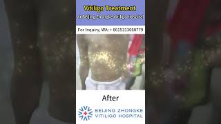 Vititiligo Treatment At Beijing Zhongke Vitiligo Hospital vitiligo vitiligotreatment [upl. by Trevorr]