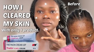 THE TRETINOIN NIGHT ROUTINE THAT CLEARED MY SKIN  Step by step Tretinoin routine tretinoin [upl. by Sollows725]