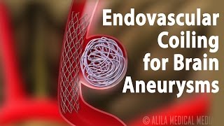 Endovascular Coiling for Brain Aneurysm Animation [upl. by Akimal64]