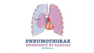 PNEUMOTHORAX  استرواح الصدر الهوائي [upl. by Eanore]