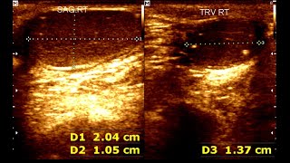 Cryptorchidism in children  Testicular Microlithiasis  Undescended testis [upl. by Ydolem]