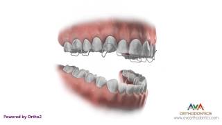 Orthodontic Retainer  Hawley  Instruction and Care [upl. by Blackstock]