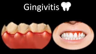 🦷 Gingivitis  Cavidad oral  Cabeza y Cuello  Patología [upl. by Davide]