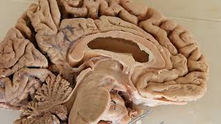 Third Ventricle  neuroanatomy  boundaries  recesses [upl. by Mufi]