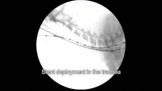 Veterinary Bronchoscopy584 Tracheal Stent Placement for Primary Tracheal Collapse in dog [upl. by Gnohp]