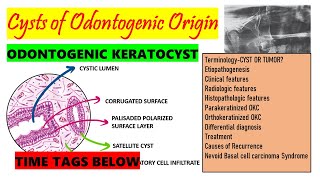 Odontogenic Keratocyst HISTOPATHOLOGY TREATMENT  Causes of recurrence DETAILED part 2 Time tag [upl. by Walden235]