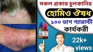 চুলকানির হোমিও ঔষধ ।। চুলকানি ।। Chulkanir Homeo Osudh ।। Top Skin Problem Homeo Medicine [upl. by Smiley]