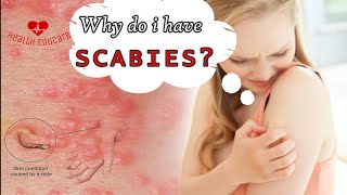 Scabies mites coming out of my skin [upl. by Nileve391]