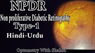 Non Proliferative Diabetic Retinopathy  Part1  Optometry With Shahid [upl. by Jaqitsch]