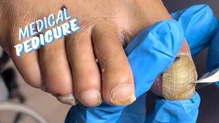 HOW TO GET BUTTERY SOFT FEET MEDICAL PEDICURE [upl. by Adnamar]