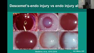 Steven E Wilson MD Update on the use of Topical losartan for corneal scarring 6 11 24 [upl. by Gonzales]