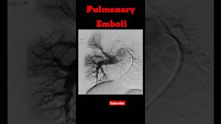 Pulmonary Emboli shorts pulmonaryembolism radiology pulmonarydisease [upl. by Maddy608]