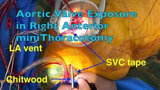 AV exposure maneuver during Aortic Valve Replacement through the Right Anterior miniThoracotomy [upl. by Harleigh231]