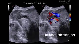 Изменения печени при эхинококкозе Changes in the liver during echinococcosis [upl. by Stone11]