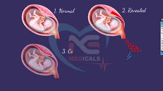 abruptio placenta NGMedicals [upl. by Asiat]