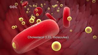 Arteriosclerosis [upl. by Babcock]