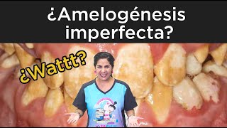 Amelogénesis imperfecta [upl. by Bendick]