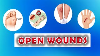 Types of Open Wounds Abrasion Laceration Skin Avulsion Puntured wounds [upl. by Odlonra]