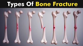 Common types of Bone fracture  3D animation [upl. by Jilleen]