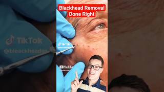 Crazy Satisfying BLACKHEAD REMOVAL  Perfect Extraction shorts [upl. by Capon55]