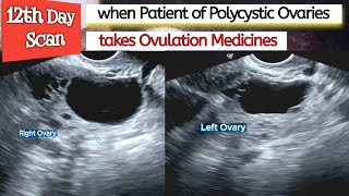 Ovarian CYSTS  Ovulation Medicines in PCOS Patient  Polycystic Ovaries  Infertility [upl. by Zeeba103]