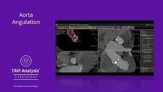 TAVI Analysis overview [upl. by Any]