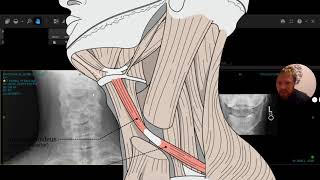 Omohyoid Syndrome  rare neck pathology [upl. by Nnayllas]