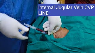 CVP line procedure through intra jugular veinenglish hospital telugu viralvideo [upl. by Iznik94]